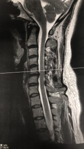 頚部ヘルニア30代女性MRI画像